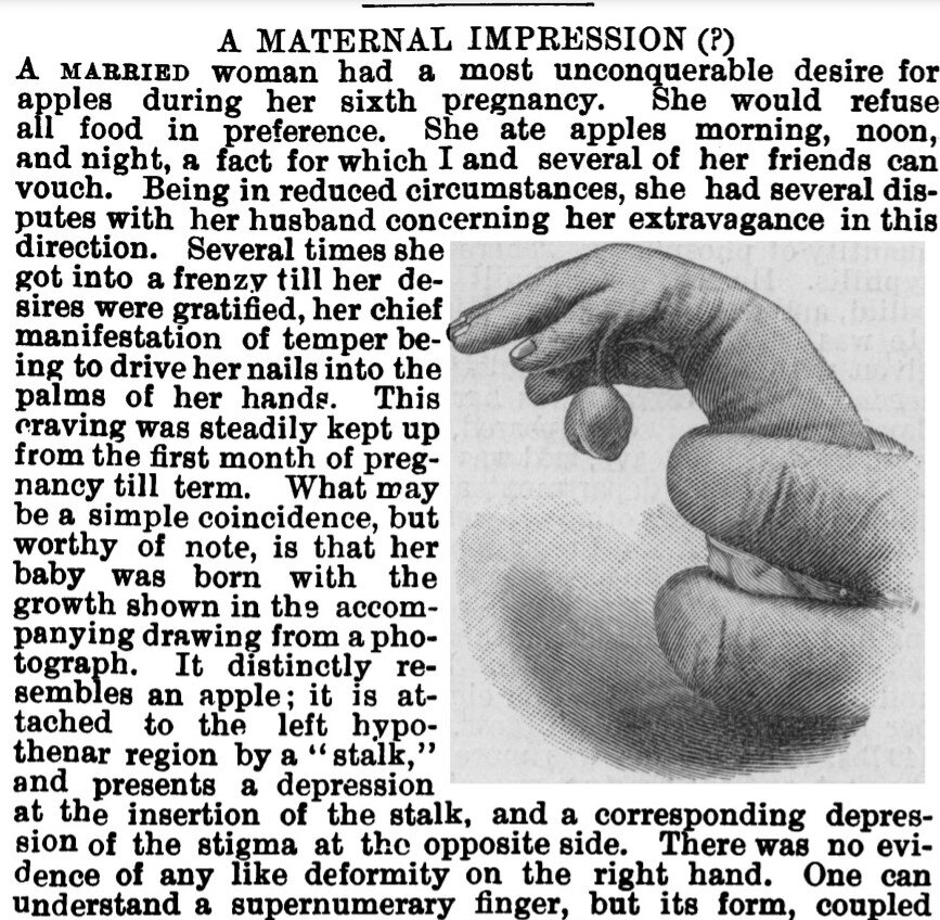 Kuva 3. Lapsen epämuodostumat voitiin joskus selittää äidin raskaudenaikaisilla mielihaluilla. 1800-luvun lopulla British Medical Journalissa pohdittiin, aiheuttiko raskaana olleen naisen omenanhimo lapsen sormeen tulleen epämuodostuman. British Medical Journal, 1893. Kuva: Anna Niiranen.